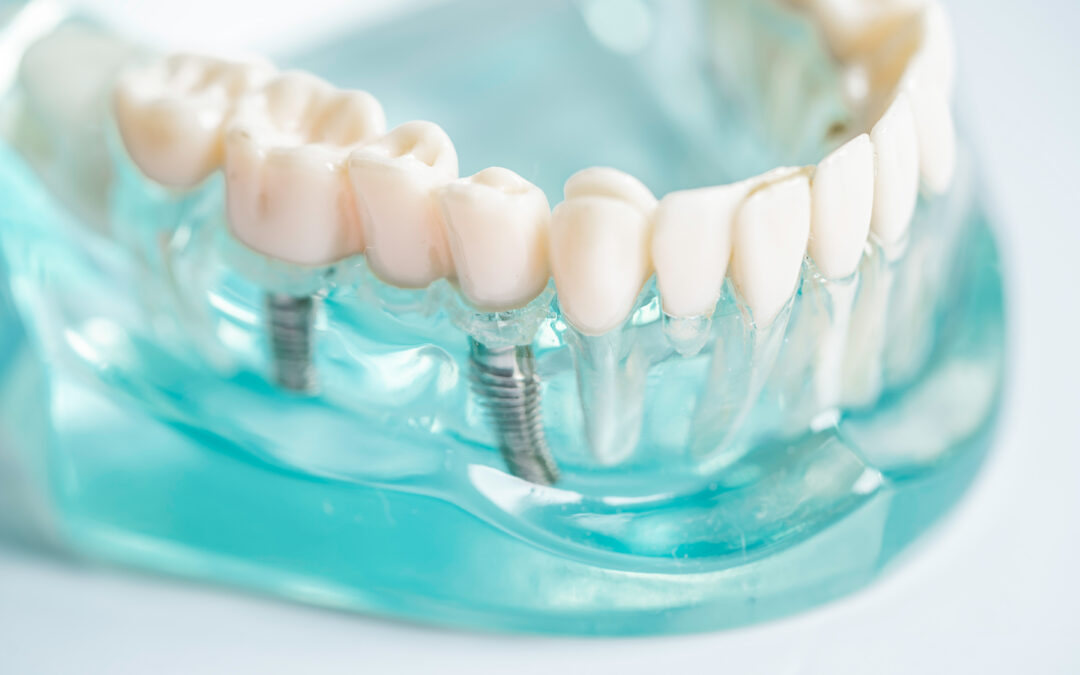 5 Things to Stay Away from When Marketing Dental Implants